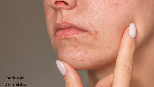Periorale Dermatitis: Wenn die Ursache nicht in der Hautpflege liegt